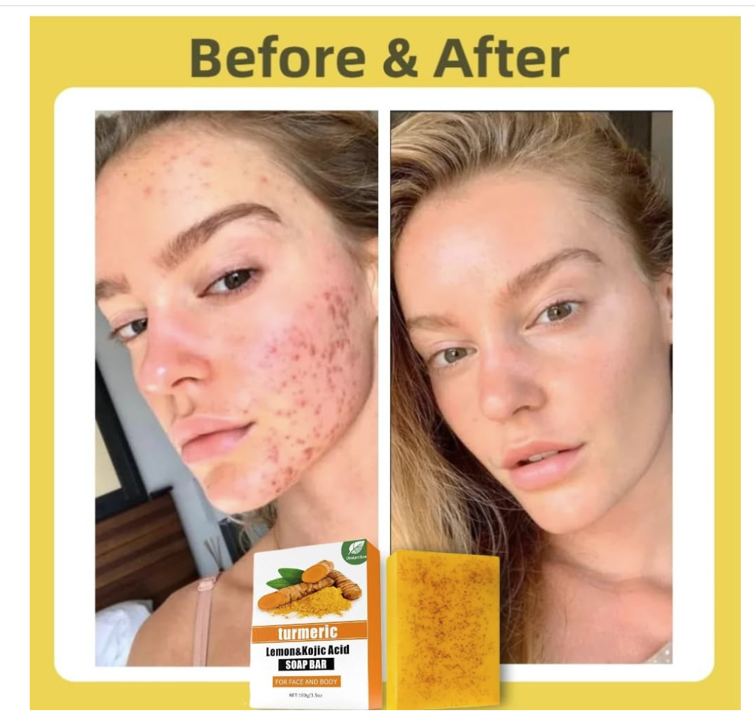 Lemon Turmeric Kojic Soap Bar for All Skin Types